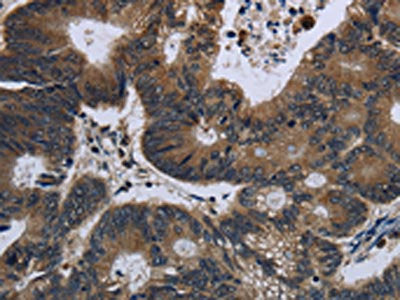 The image on the left is immunohistochemistry of paraffin-embedded Human colon cancer tissue using CSB-PA209664(GK Antibody) at dilution 1/60, on the right is treated with fusion protein. (Original magnification: ×200)