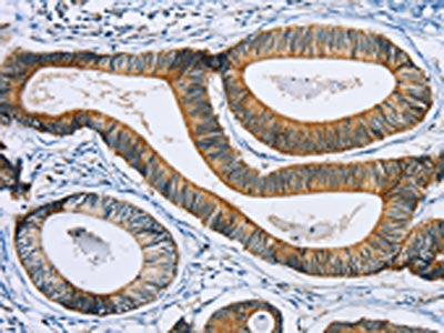 The image on the left is immunohistochemistry of paraffin-embedded Human colon cancer tissue using CSB-PA209693(SULT1B1 Antibody) at dilution 1/30, on the right is treated with fusion protein. (Original magnification: ×200)