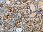 The image on the left is immunohistochemistry of paraffin-embedded Human thyroid cancer tissue using CSB-PA209741(MAD2L1 Antibody) at dilution 1/25, on the right is treated with fusion protein. (Original magnification: ×200)