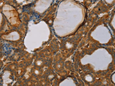 The image on the left is immunohistochemistry of paraffin-embedded Human thyroid cancer tissue using CSB-PA209755(PAGE2 Antibody) at dilution 1/20, on the right is treated with fusion protein. (Original magnification: ×200)