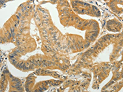 The image on the left is immunohistochemistry of paraffin-embedded Human colon cancer tissue using CSB-PA209872(TAGLN2 Antibody) at dilution 1/35, on the right is treated with fusion protein. (Original magnification: ×200)
