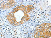 The image on the left is immunohistochemistry of paraffin-embedded Human cervical cancer tissue using CSB-PA210142(ASNS Antibody) at dilution 1/60, on the right is treated with fusion protein. (Original magnification: ×200)