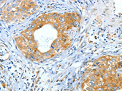 The image on the left is immunohistochemistry of paraffin-embedded Human cervical cancer tissue using CSB-PA210142(ASNS Antibody) at dilution 1/60, on the right is treated with fusion protein. (Original magnification: ×200)