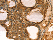 The image on the left is immunohistochemistry of paraffin-embedded Human thyroid cancer tissue using CSB-PA210339(TAF11 Antibody) at dilution 1/40, on the right is treated with fusion protein. (Original magnification: ×200)