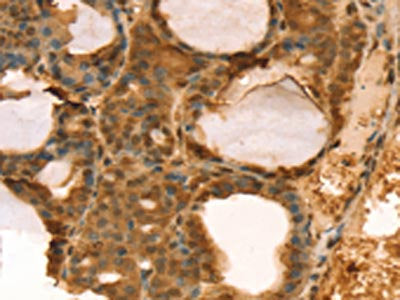 The image on the left is immunohistochemistry of paraffin-embedded Human thyroid cancer tissue using CSB-PA210339(TAF11 Antibody) at dilution 1/40, on the right is treated with fusion protein. (Original magnification: ×200)