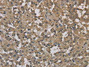 The image on the left is immunohistochemistry of paraffin-embedded Human thyroid cancer tissue using CSB-PA210409(DCTN3 Antibody) at dilution 1/70, on the right is treated with fusion protein. (Original magnification: ×200)