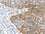 The image on the left is immunohistochemistry of paraffin-embedded Human lung cancer tissue using CSB-PA210438(CRADD Antibody) at dilution 1/25, on the right is treated with fusion protein. (Original magnification: ×200)
