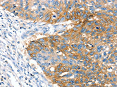 The image on the left is immunohistochemistry of paraffin-embedded Human lung cancer tissue using CSB-PA210438(CRADD Antibody) at dilution 1/25, on the right is treated with fusion protein. (Original magnification: ×200)