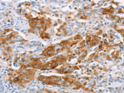 The image on the left is immunohistochemistry of paraffin-embedded Human prostate cancer tissue using CSB-PA210441(C3AR1 Antibody) at dilution 1/25, on the right is treated with fusion protein. (Original magnification: ×200)