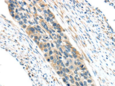 The image on the left is immunohistochemistry of paraffin-embedded Human esophagus cancer tissue using CSB-PA210502(VWCE Antibody) at dilution 1/30, on the right is treated with synthetic peptide. (Original magnification: ×200)