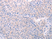 The image on the left is immunohistochemistry of paraffin-embedded Human liver cancer tissue using CSB-PA210868(SPATA6 Antibody) at dilution 1/40, on the right is treated with fusion protein. (Original magnification: ×200)
