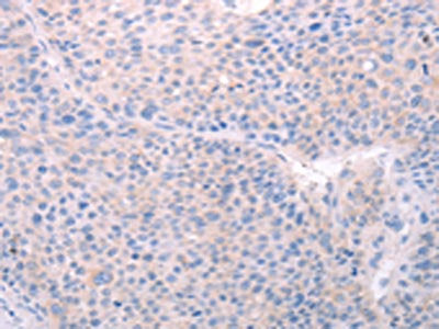The image on the left is immunohistochemistry of paraffin-embedded Human liver cancer tissue using CSB-PA210868(SPATA6 Antibody) at dilution 1/40, on the right is treated with fusion protein. (Original magnification: ×200)