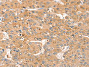 The image on the left is immunohistochemistry of paraffin-embedded Human liver cancer tissue using CSB-PA210932(SMOC2 Antibody) at dilution 1/35, on the right is treated with synthetic peptide. (Original magnification: ×200)