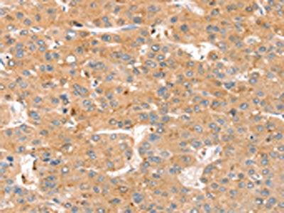 The image on the left is immunohistochemistry of paraffin-embedded Human liver cancer tissue using CSB-PA210932(SMOC2 Antibody) at dilution 1/35, on the right is treated with synthetic peptide. (Original magnification: ×200)