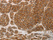 The image on the left is immunohistochemistry of paraffin-embedded Human liver cancer tissue using CSB-PA210969(PRDX3 Antibody) at dilution 1/50, on the right is treated with synthetic peptide. (Original magnification: ×200)