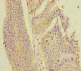 Immunohistochemistry of paraffin-embedded human colon cancer using CSB-PA2109ESR1HU at dilution of 1:100