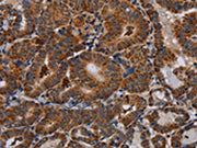The image on the left is immunohistochemistry of paraffin-embedded Human thyroid cancer tissue using CSB-PA211015(DISC1 Antibody) at dilution 1/30, on the right is treated with synthetic peptide. (Original magnification: ×200)
