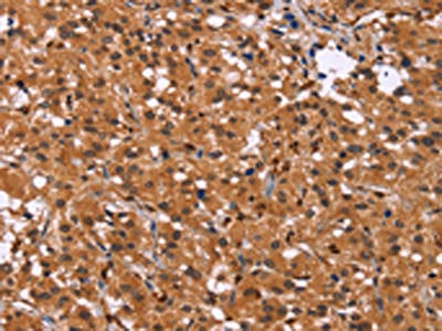 The image on the left is immunohistochemistry of paraffin-embedded Human thyroid cancer tissue using CSB-PA211136(HDLBP Antibody) at dilution 1/30, on the right is treated with synthetic peptide. (Original magnification: ×200)