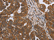 The image on the left is immunohistochemistry of paraffin-embedded Human ovarian cancer tissue using CSB-PA211169(NDUFAF4 Antibody) at dilution 1/50, on the right is treated with synthetic peptide. (Original magnification: ×200)