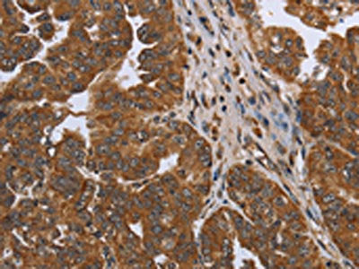 The image on the left is immunohistochemistry of paraffin-embedded Human ovarian cancer tissue using CSB-PA211169(NDUFAF4 Antibody) at dilution 1/50, on the right is treated with synthetic peptide. (Original magnification: ×200)