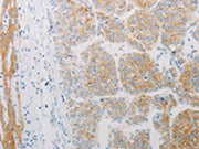 The image on the left is immunohistochemistry of paraffin-embedded Human liver cancer tissue using CSB-PA211297(ADRB2 Antibody) at dilution 1/20, on the right is treated with synthetic peptide. (Original magnification: ×200)