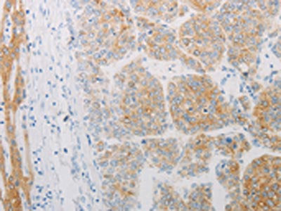 The image on the left is immunohistochemistry of paraffin-embedded Human liver cancer tissue using CSB-PA211297(ADRB2 Antibody) at dilution 1/20, on the right is treated with synthetic peptide. (Original magnification: ×200)