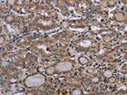 The image on the left is immunohistochemistry of paraffin-embedded Human thyroid cancer tissue using CSB-PA211403(P2RX2 Antibody) at dilution 1/50, on the right is treated with synthetic peptide. (Original magnification: ×200)