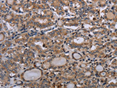 The image on the left is immunohistochemistry of paraffin-embedded Human thyroid cancer tissue using CSB-PA211403(P2RX2 Antibody) at dilution 1/50, on the right is treated with synthetic peptide. (Original magnification: ×200)