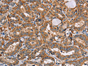 The image on the left is immunohistochemistry of paraffin-embedded Human thyroid cancer tissue using CSB-PA211579(AAAS Antibody) at dilution 1/20, on the right is treated with fusion protein. (Original magnification: ×200)