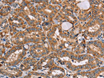 The image on the left is immunohistochemistry of paraffin-embedded Human thyroid cancer tissue using CSB-PA211579(AAAS Antibody) at dilution 1/20, on the right is treated with fusion protein. (Original magnification: ×200)