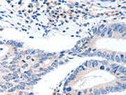 The image on the left is immunohistochemistry of paraffin-embedded Human colon cancer tissue using CSB-PA211635(GCK Antibody) at dilution 1/40, on the right is treated with synthetic peptide. (Original magnification: ×200)