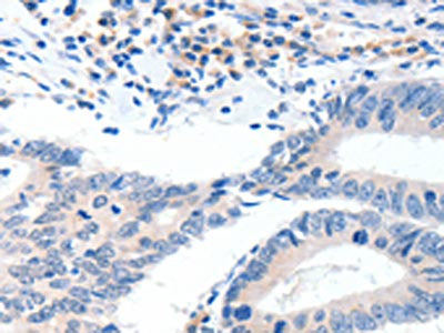 The image on the left is immunohistochemistry of paraffin-embedded Human colon cancer tissue using CSB-PA211635(GCK Antibody) at dilution 1/40, on the right is treated with synthetic peptide. (Original magnification: ×200)