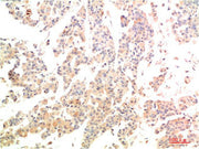Immunohistochemical analysis of paraffin-embedded Human Breast Carcinoma Tissue using MEK3 Rabbit pAb diluted at 1:200