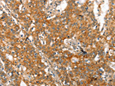 The image on the left is immunohistochemistry of paraffin-embedded Human gastic cancer tissue using CSB-PA211774(MMP2 Antibody) at dilution 1/60, on the right is treated with synthetic peptide. (Original magnification: ×200)