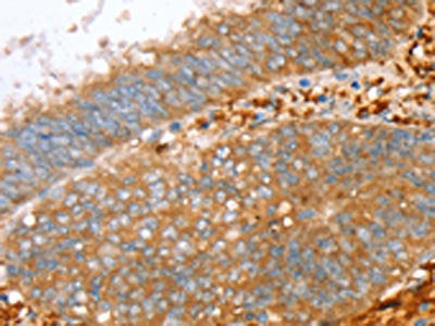 The image on the left is immunohistochemistry of paraffin-embedded Human cervical cancer tissue using CSB-PA211886(PTPN7 Antibody) at dilution 1/30, on the right is treated with fusion protein. (Original magnification: ×200)