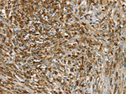 The image on the left is immunohistochemistry of paraffin-embedded Human cervical cancer tissue using CSB-PA211930(SIK1 Antibody) at dilution 1/40, on the right is treated with synthetic peptide. (Original magnification: ×200)