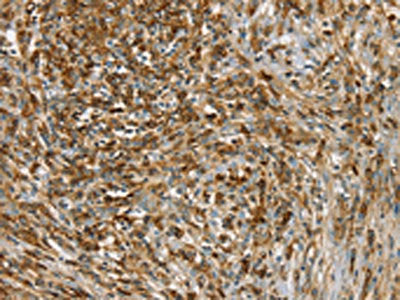 The image on the left is immunohistochemistry of paraffin-embedded Human cervical cancer tissue using CSB-PA211930(SIK1 Antibody) at dilution 1/40, on the right is treated with synthetic peptide. (Original magnification: ×200)