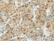 The image on the left is immunohistochemistry of paraffin-embedded Human liver cancer tissue using CSB-PA211960(TRIB1 Antibody) at dilution 1/20, on the right is treated with synthetic peptide. (Original magnification: ×200)