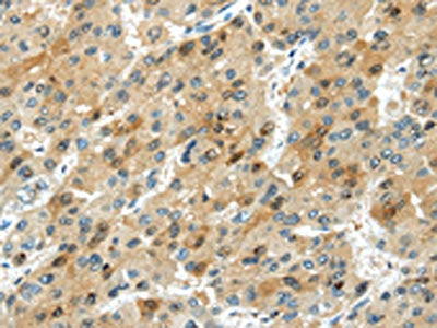 The image on the left is immunohistochemistry of paraffin-embedded Human liver cancer tissue using CSB-PA211960(TRIB1 Antibody) at dilution 1/20, on the right is treated with synthetic peptide. (Original magnification: ×200)