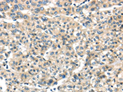 The image on the left is immunohistochemistry of paraffin-embedded Human liver cancer tissue using CSB-PA212086(THAP2 Antibody) at dilution 1/20, on the right is treated with fusion protein. (Original magnification: ×200)
