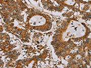 The image on the left is immunohistochemistry of paraffin-embedded Human colon cancer tissue using CSB-PA212278(MB Antibody) at dilution 1/25, on the right is treated with fusion protein. (Original magnification: ×200)