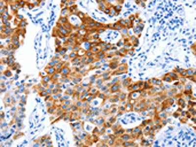 The image on the left is immunohistochemistry of paraffin-embedded Human lung cancer tissue using CSB-PA212285(PROM1 Antibody) at dilution 1/40, on the right is treated with synthetic peptide. (Original magnification: ×200)