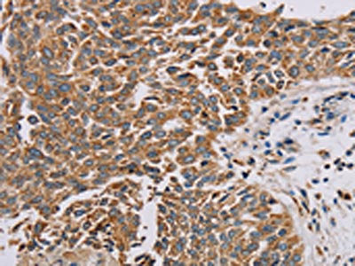 The image on the left is immunohistochemistry of paraffin-embedded Human lung cancer tissue using CSB-PA212466(PLEKHG6 Antibody) at dilution 1/20, on the right is treated with fusion protein. (Original magnification: ×200)