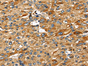 The image on the left is immunohistochemistry of paraffin-embedded Human liver cancer tissue using CSB-PA212583(STC2 Antibody) at dilution 1/25, on the right is treated with fusion protein. (Original magnification: ×200)