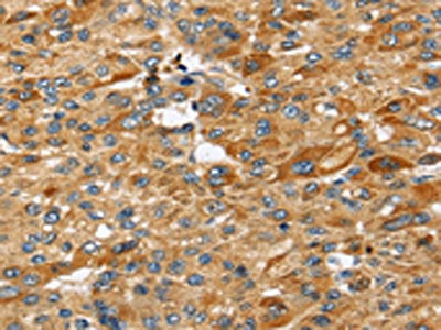 The image on the left is immunohistochemistry of paraffin-embedded Human liver cancer tissue using CSB-PA212583(STC2 Antibody) at dilution 1/25, on the right is treated with fusion protein. (Original magnification: ×200)