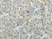 The image on the left is immunohistochemistry of paraffin-embedded Human liver cancer tissue using CSB-PA212701(AICDA Antibody) at dilution 1/35, on the right is treated with synthetic peptide. (Original magnification: ×200)