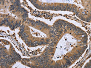 The image is immunohistochemistry of paraffin-embedded Human colon cancer tissue using CSB-PA212749(GADD45B Antibody) at dilution 1/30. (Original magnification: ×200)