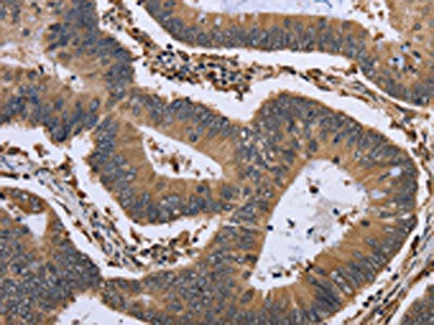 The image is immunohistochemistry of paraffin-embedded Human colon cancer tissue using CSB-PA212749(GADD45B Antibody) at dilution 1/30. (Original magnification: ×200)