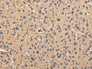 The image on the left is immunohistochemistry of paraffin-embedded Human liver cancer tissue using CSB-PA212919(BMP4 Antibody) at dilution 1/40, on the right is treated with fusion protein. (Original magnification: ×200)