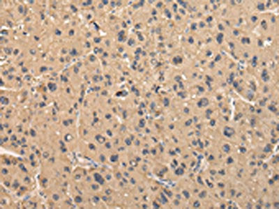 The image on the left is immunohistochemistry of paraffin-embedded Human liver cancer tissue using CSB-PA212919(BMP4 Antibody) at dilution 1/40, on the right is treated with fusion protein. (Original magnification: ×200)